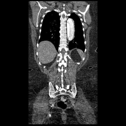 File:Aortic dissection - Stanford type B (Radiopaedia 88281-104910 B 70).jpg
