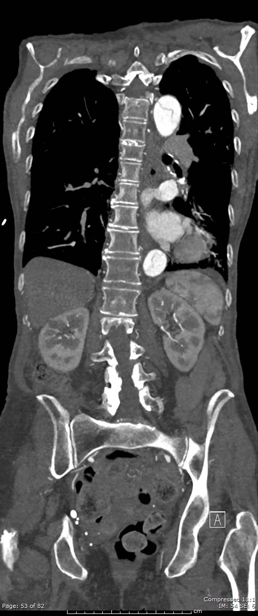Aortic dissection with extension into aortic arch branches (Radiopaedia 64402-73204 A 53).jpg