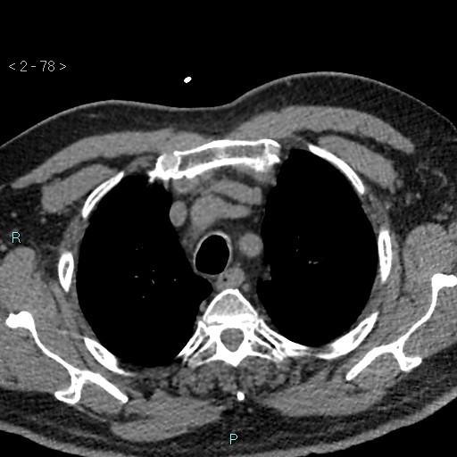 Aortic intramural hematoma (Radiopaedia 48463-53380 Axial non-contrast 34).jpg