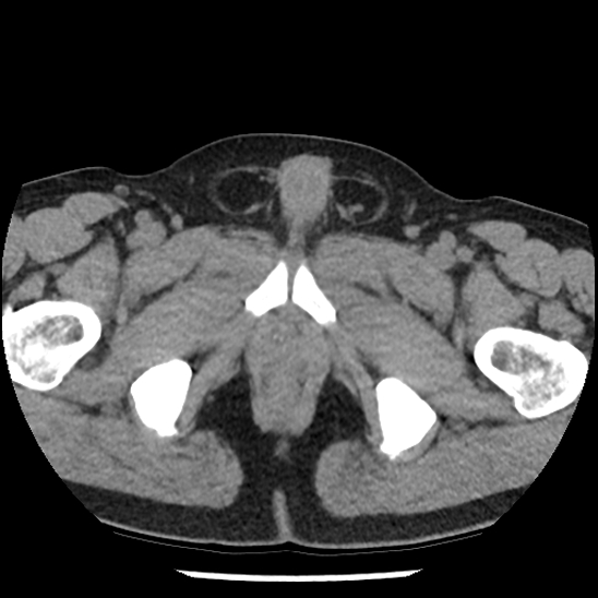 Aortic intramural hematoma (type B) (Radiopaedia 79323-92387 Axial non-contrast 119).jpg