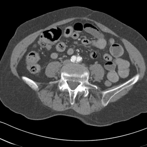 Aortic intramural hematoma from penetrating atherosclerotic ulcer (Radiopaedia 31137-31836 A 127).jpg