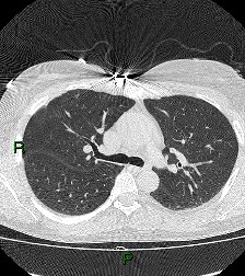File:Aortic valve endocarditis (Radiopaedia 87209-103485 Axial lung window 41).jpg