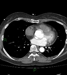 Aortic valve endocarditis (Radiopaedia 87209-103485 C 58).jpg
