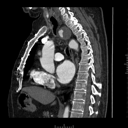 File:Aorto-coronary bypass graft aneurysms (Radiopaedia 40562-43157 C 18).png