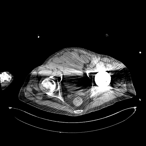 Aortoduodenal fistula (Radiopaedia 75286-86415 Axial non-contrast 71).jpg