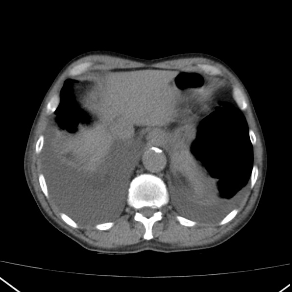 Aortoiliac occlusive disease (Radiopaedia 32134-33076 Axial non-contrast 7).jpg