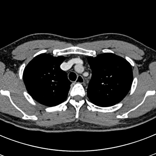 File:Apical lung mass mimic - neurogenic tumor (Radiopaedia 59918-67521 A 21).jpg