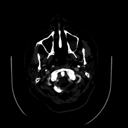 Aplasia of the internal carotid artery (Radiopaedia 61082-68960 A 5).jpg