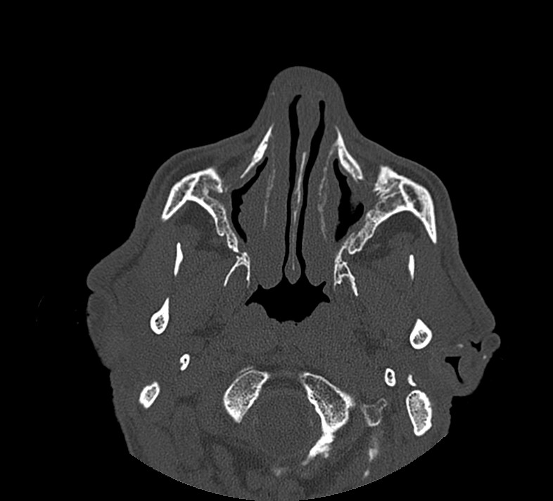 Aplastic maxillary sinuses (Radiopaedia 60030-67561 Axial non-contrast 23).jpg