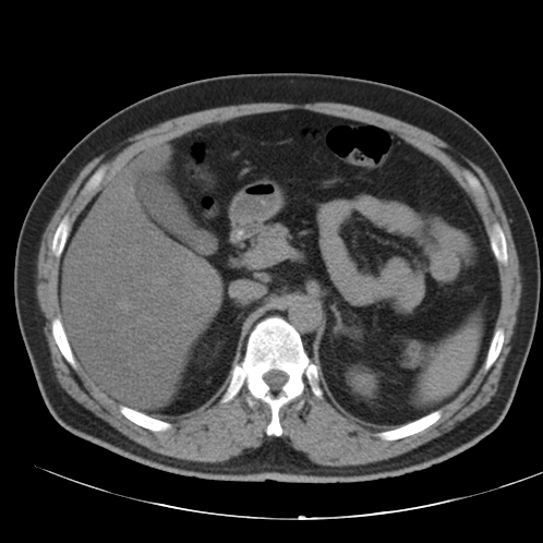 File:Appendicitis and giant appendicolith (Radiopaedia 80251-93588 Axial non-contrast 13).jpg