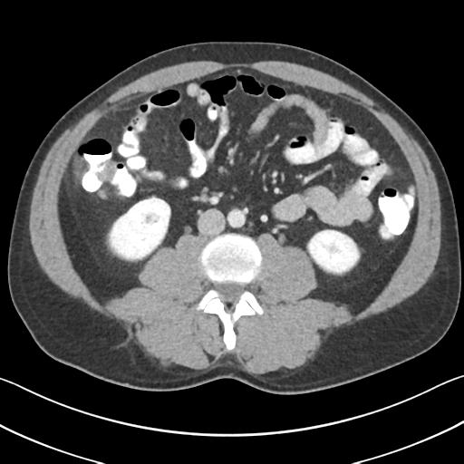 File:Appendicitis with cecal bar sign (Radiopaedia 31878-32830 B 43).jpg