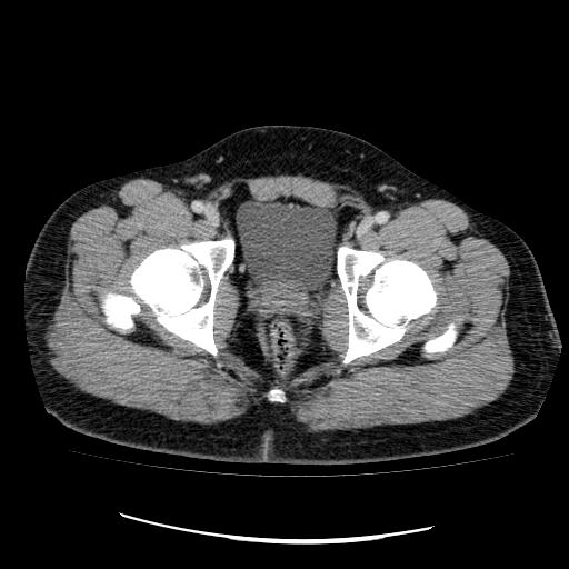 File:Appendicitis with diverticulosis (Radiopaedia 47693-52383 Axial C+ 139).jpg