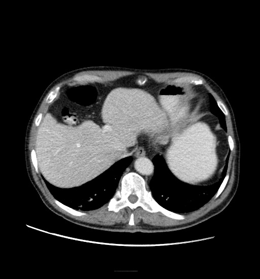 File:Appendicitis with localized perforation and abscess formation (Radiopaedia 49035-54130 A 19).jpg