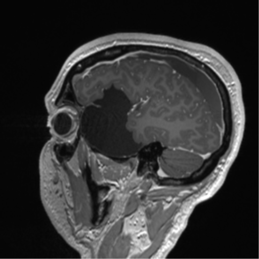 Arachnoid cyst with subdural hematoma (Radiopaedia 85892-101743 Sagittal T1 C+ 25).png