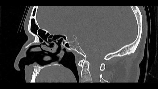 Arcuate foramen (Radiopaedia 89833-106944 Sagittal bone window 63).jpg