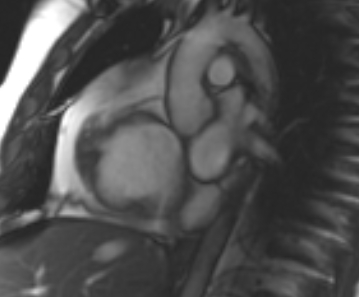 Arrhythmogenic right ventricular cardiomyopathy (Radiopaedia 69431-79307 Short axis cine 236).jpg