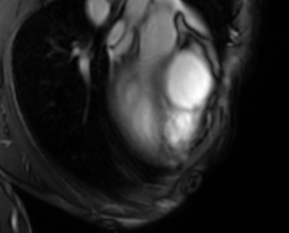 File:Arrhythmogenic right ventricular cardiomyopathy (Radiopaedia 69564-79464 4ch cine 10).jpg