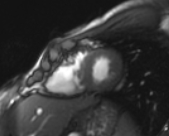 Arrhythmogenic right ventricular cardiomyopathy (Radiopaedia 69564-79464 short axis cine 88).jpg