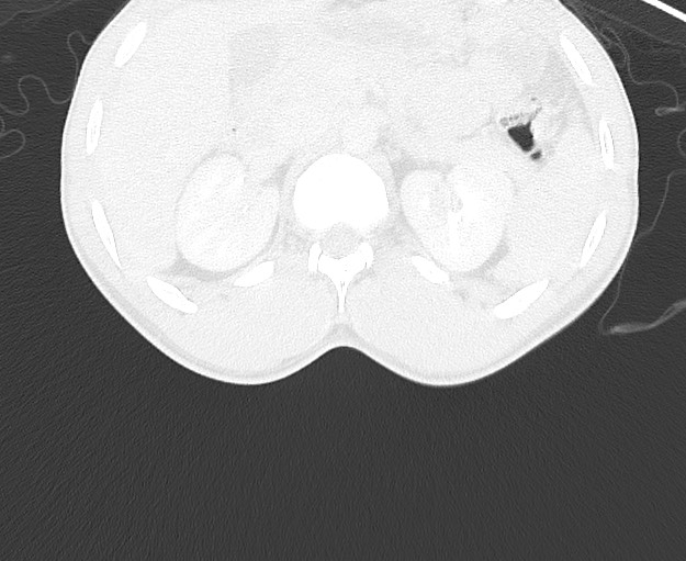 Arrow injury to the chest (Radiopaedia 75223-86321 Axial lung window 118).jpg