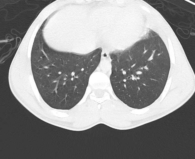 Arrow injury to the chest (Radiopaedia 75223-86321 Axial lung window 67).jpg