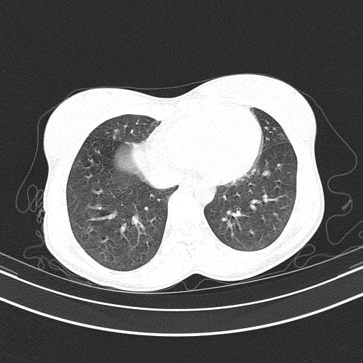 Arteria lusoria (Radiopaedia 88528-105192 Axial lung window 45).jpg