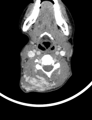 Arteriovenous malformation of the neck (Radiopaedia 53935-60062 B 23).jpg