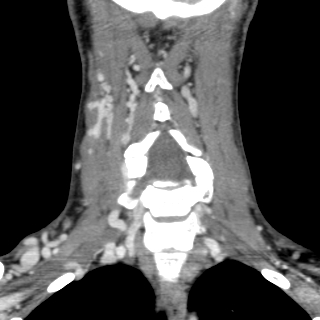Arteriovenous malformation of the neck (Radiopaedia 53935-60062 D 22).jpg