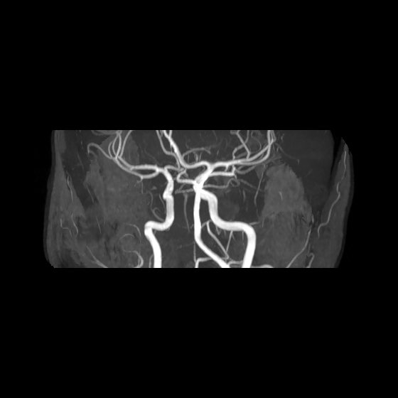 File:Artery of Percheron infarct (Radiopaedia 40966-43676 G 37).jpg