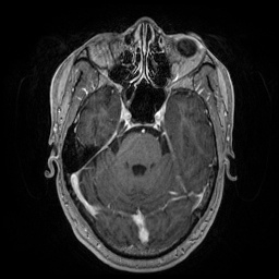File:Artery of Percheron infarction (Radiopaedia 27975-28230 Axial T1 C+ fat sat 31).jpg