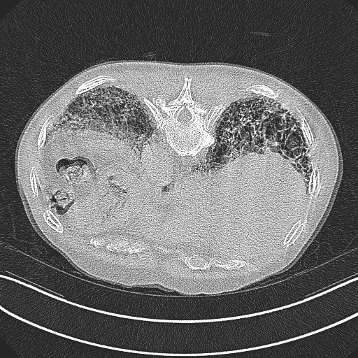 File:Aspergilloma on background pulmonary fibrosis (Radiopaedia 60942-68757 Axial lung window 25).jpg