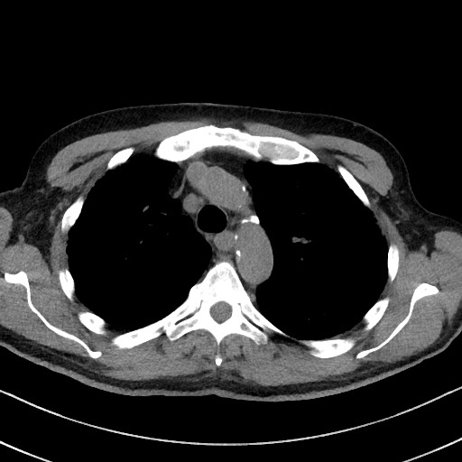 Aspergilloma on background pulmonary fibrosis (Radiopaedia 60942-68757 Axial non-contrast 19).jpg