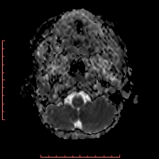 Astroblastoma (Radiopaedia 74287-85162 Axial ADC 1).jpg