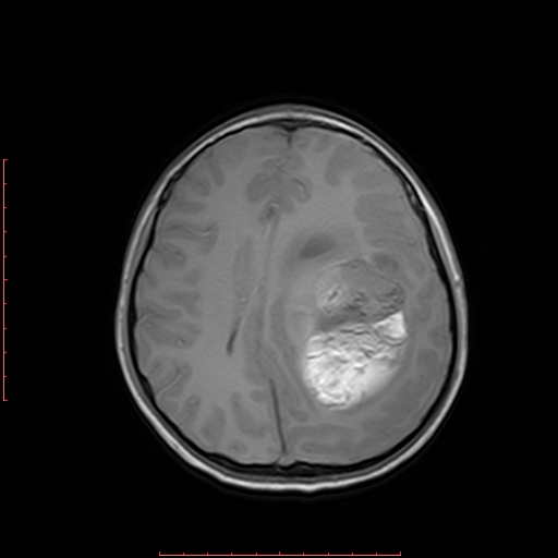 File:Astroblastoma (Radiopaedia 74287-85162 Axial T1 14).jpg