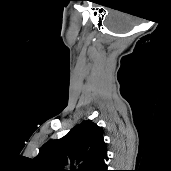 File:Atlanto-occipital dissociation (Traynelis type 1), C2 teardrop fracture, C6-7 facet joint dislocation (Radiopaedia 87655-104061 D 67).jpg