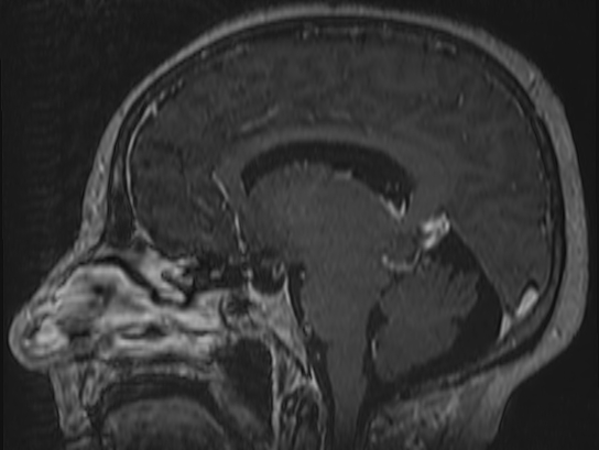 Atypical meningioma (Radiopaedia 62985-71406 Sagittal T1 C+ 44).jpg