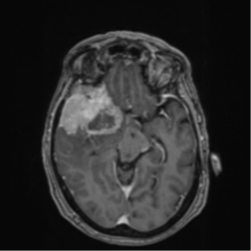 Atypical meningioma (WHO Grade II) (Radiopaedia 54742-60979 Axial T1 C+ 26).png