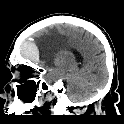 Atypical meningioma (WHO grade II) with brain invasion (Radiopaedia 57767-64728 Sagittal C+ 19).png
