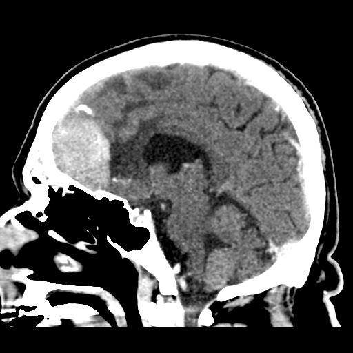 Atypical meningioma (WHO grade II) with brain invasion (Radiopaedia 57767-64728 Sagittal C+ 24).png