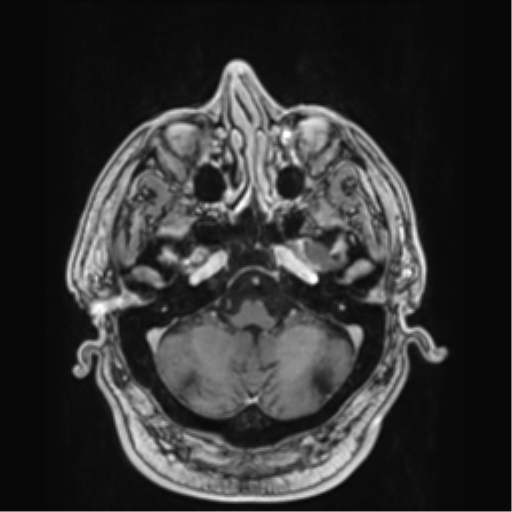 Atypical meningioma (WHO grade II) with brain invasion (Radiopaedia 57767-64729 Axial T1 C+ 9).png