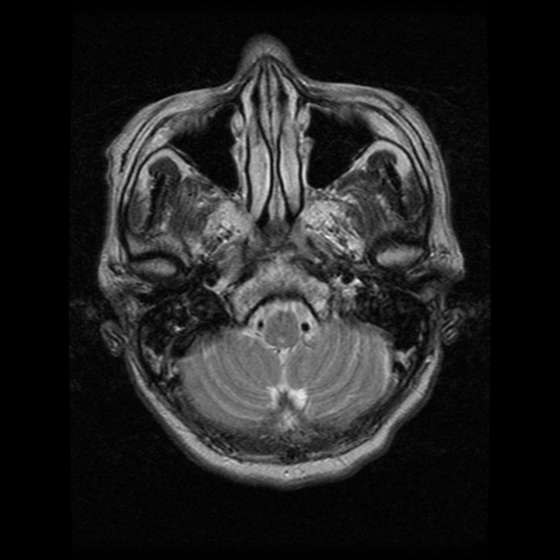 File:Atypical meningioma (WHO grade II) with osseous invasion (Radiopaedia 53654-59716 Axial T2 3).png