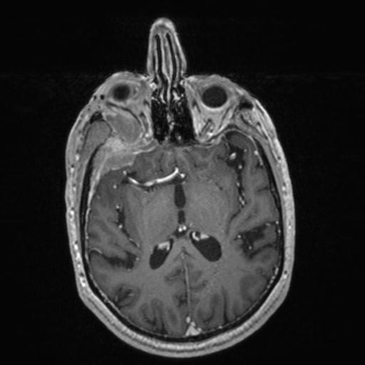 Atypical meningioma (grade II) - en plaque (Radiopaedia 29633-30147 Axial T1 C+ 97).jpg