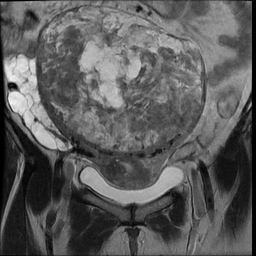 File:Atypical retroperitoneal lymphocoeles with large leiomyoma of uterus (Radiopaedia 32084-33027 Coronal T2 13).jpg