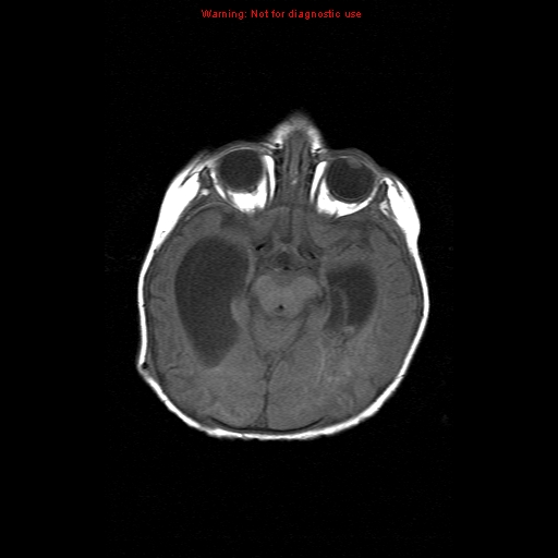 File:Atypical teratoid rhabdoid tumor (Radiopaedia 10712-11183 Axial T1 11).jpg