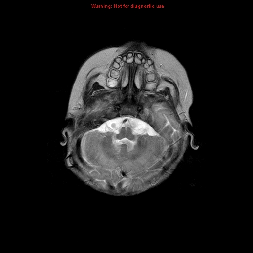 File:Atypical teratoid rhabdoid tumor (Radiopaedia 10712-11183 Axial T2 14).jpg