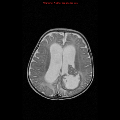 File:Atypical teratoid rhabdoid tumor (Radiopaedia 10712-11183 Axial T2 6).jpg