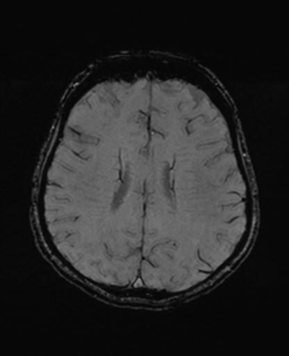 Autoimmune limbic encephalitis (Radiopaedia 30363-31005 SWI 51).jpg