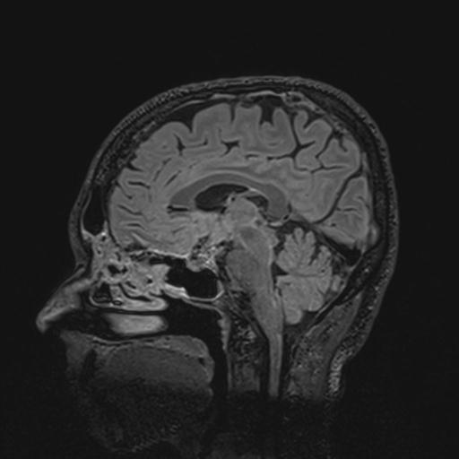 Autoimmune limbic encephalitis (Radiopaedia 30363-31005 Sagittal FLAIR 84).jpg