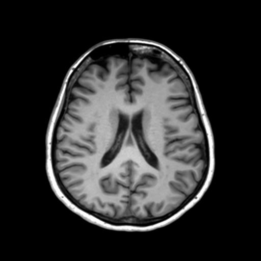 Autoimmune limbic encephalitis (Radiopaedia 30363-31005 T1 Axial 3mm 31).jpg