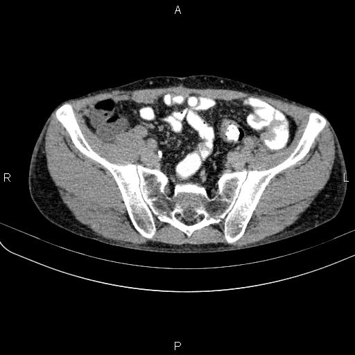 File:Autoimmune pancreatitis (Radiopaedia 84925-100431 Axial C+ delayed 71).jpg
