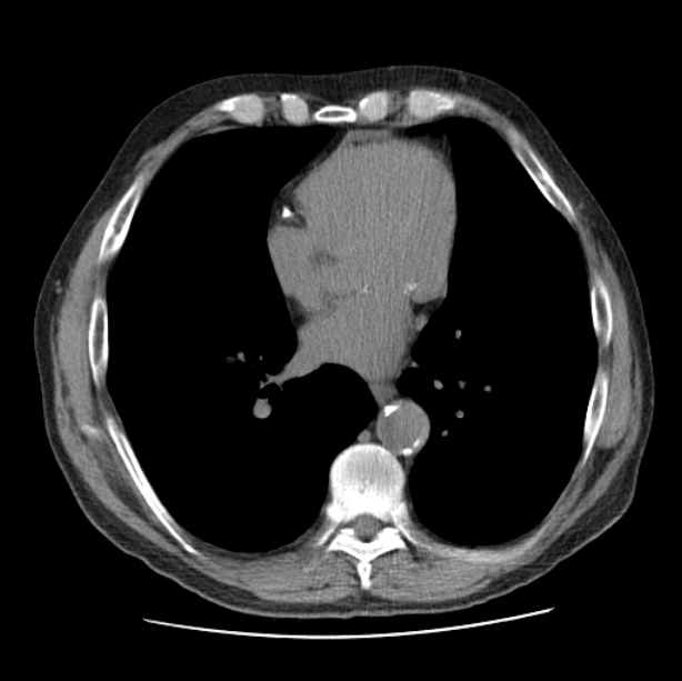 Autosomal dominant polycystic kidney disease (Radiopaedia 27851-28094 Axial non-contrast 35).jpg